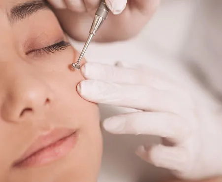 Frau mit geschlossenen Augen wird professionell mit einem Komedonenquetscher behandelt
